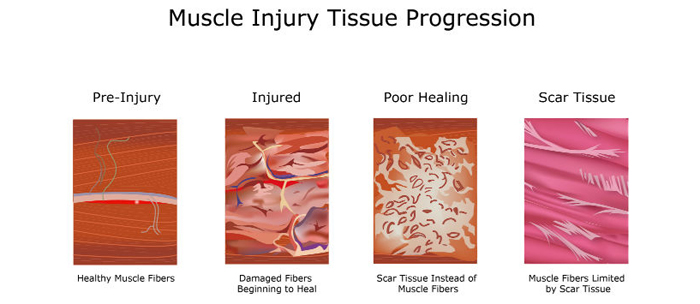 Graston Technique for Muscle Scar Tissue Removal